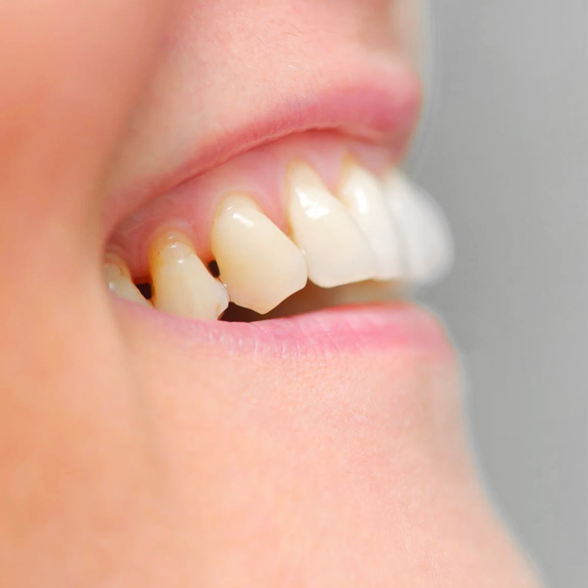 Kaksi kolmesta sairastaa tätä hiljaista tulehdussairautta